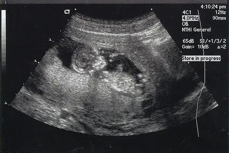 A mother’s DNA contains enough information to sequence a fetal genome.
