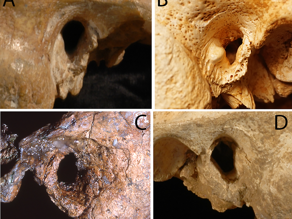 Neanderthal Ear Growths
