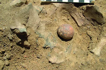 The walnut-sized stone likely caused back pain, leg pain and difficulty urinating.