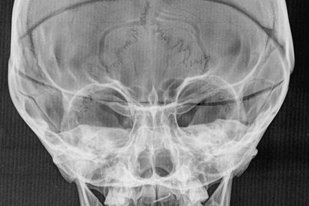 Five-year-old don Filippino’s abnormally swollen skull.