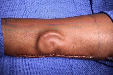 U.S. Army surgeons grew an ear in a soldier's forearm before transplanting it to the head. The solider had lost her own ear during a car accident.