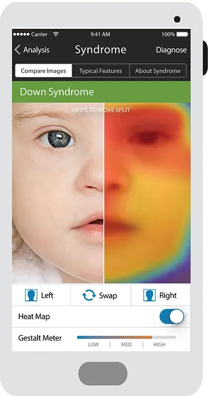 This App Uses Facial Recognition Software to Help Identify Genetic Conditions