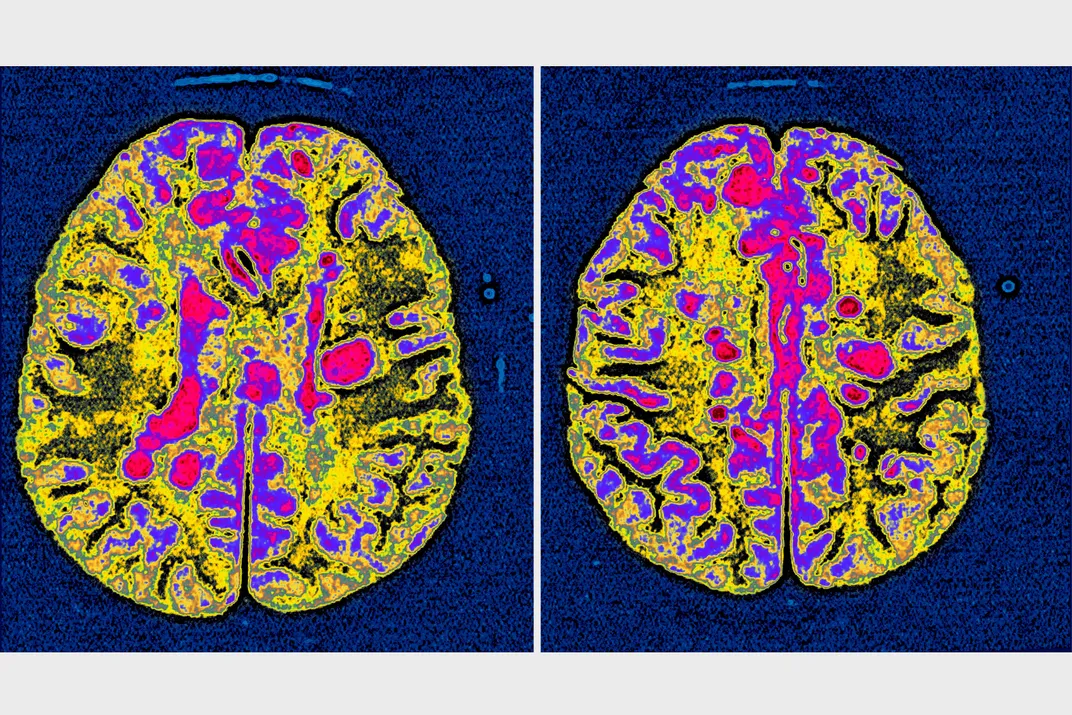 Two brain scans showing a horizontal slice of the brain. The scans reveal scar tissue associated with multiple sclerosis.