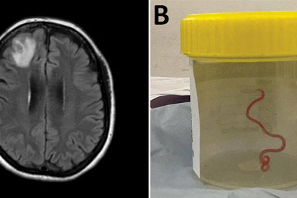 Side-by-side showing brain scan and worm in solution