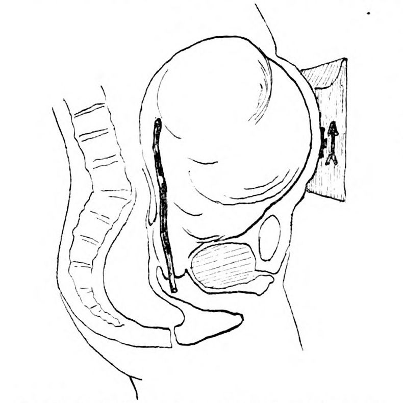 Diagram of uterus with celluloid vial of radium
