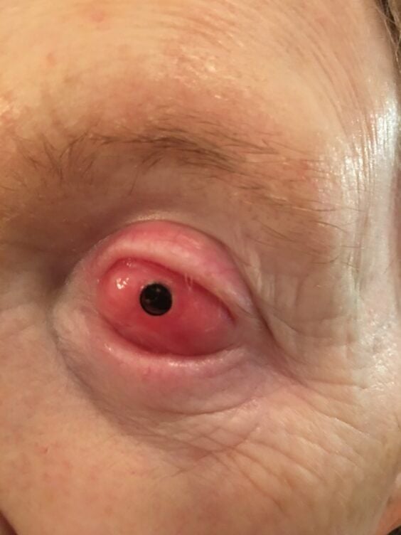 Close-up of pink tissue with a black dot in a person's eye