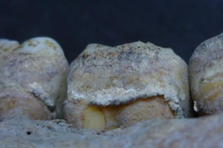 The researchers analyzed snippets of DNA left in the centuries-old tartar buildup.