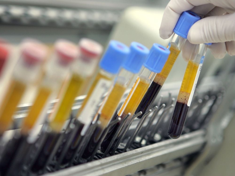 A row of blood samples in vials