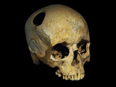 The trepanated skull of a Neolithic woman. The fact that the hole is rounded off by ingrowth of new bone suggests that the patient survived the operation.