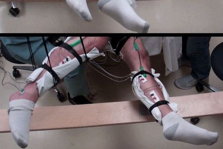A paralyzed subject moves his legs with the help of transcutaneous stimulation.