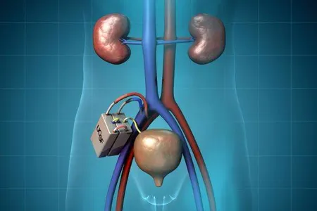 The device&nbsp;includes a hemofilter made up of silicon semiconductor membranes that remove waste products from blood and a bioreactor containing renal tubule cells that regulate water volume, electrolyte balance and other metabolic functions.