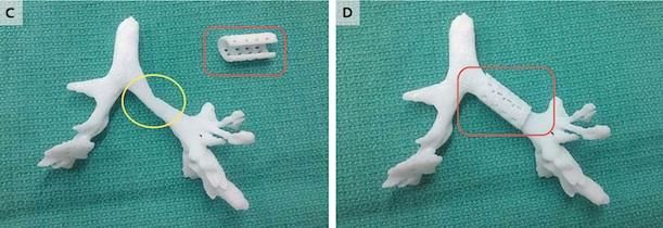 The 3D printed cast of Giondriddo’s trachea and bronchi, which the splint implanted in the image at right.