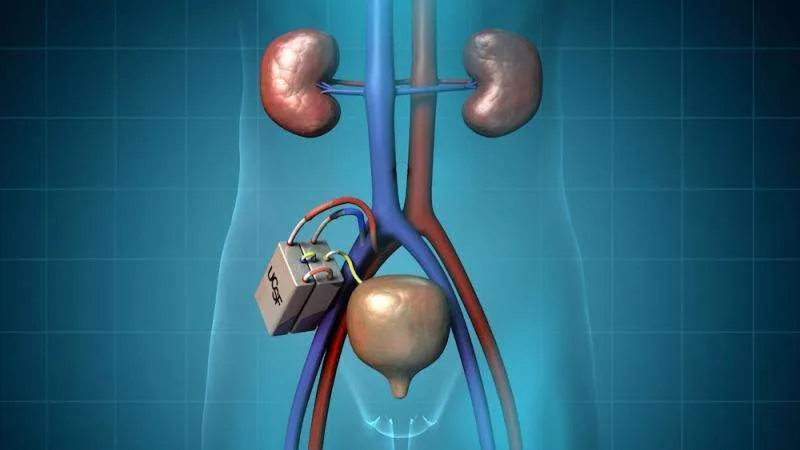 A digital illustration of what the bioartifical kidney device looks like inside the body