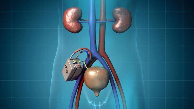 A digital illustration of what the bioartifical kidney device looks like inside the body