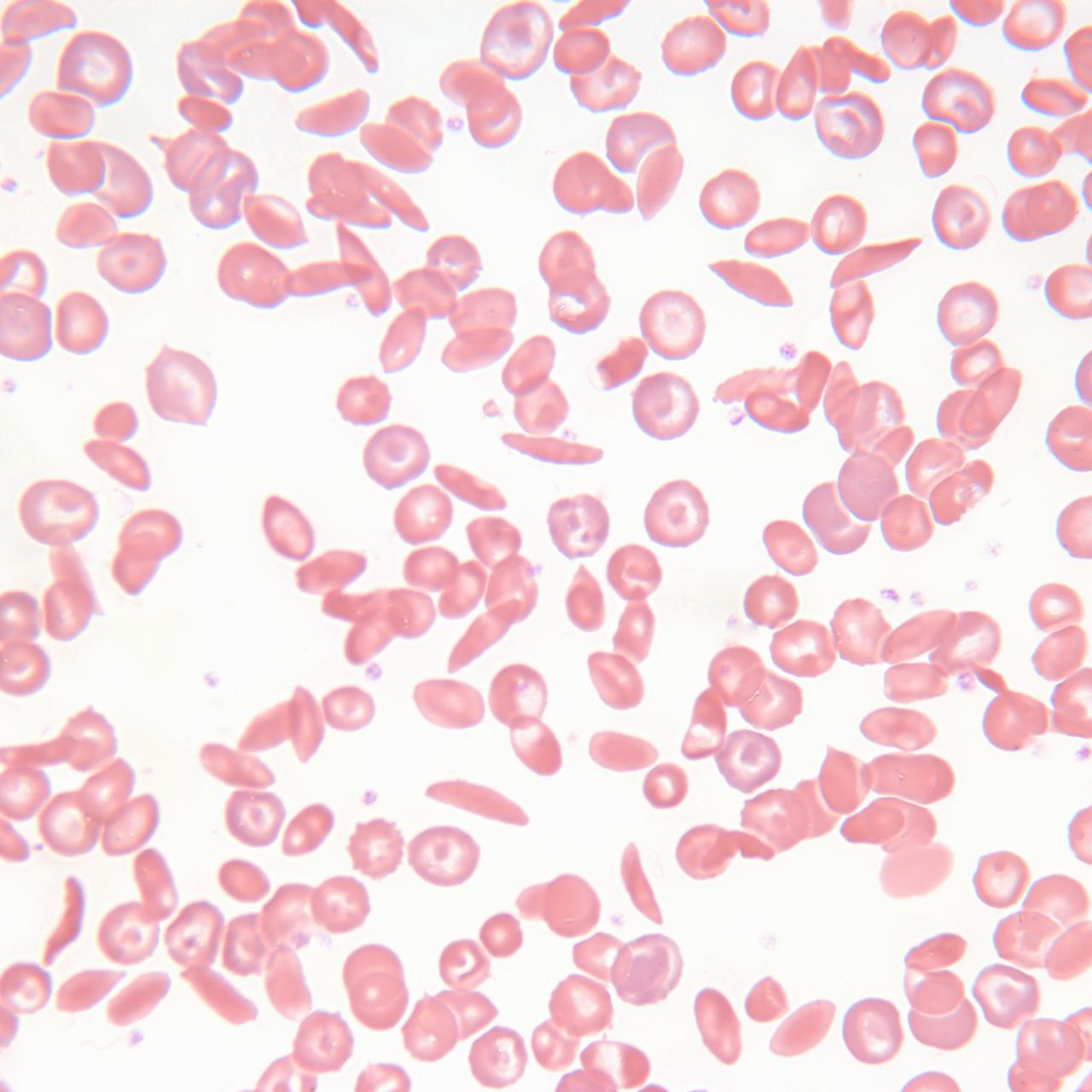 Sickle Cell Smear Blood