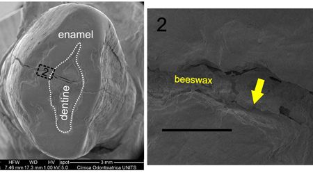 A scanning electron microscope image of the ancient tooth, and the location of the beeswax filling.