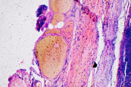 Melanoma cancer cells under a microscope