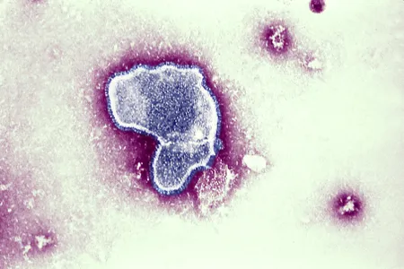 An electron micrograph of the&nbsp;respiratory syncytial virus (RSV), which kills an estimated 160,000 people worldwide each year.