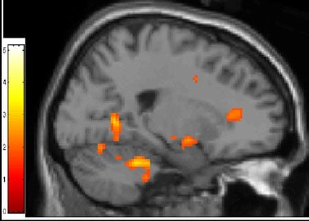 The orange dot on the right is the anterior cingulate cortex.