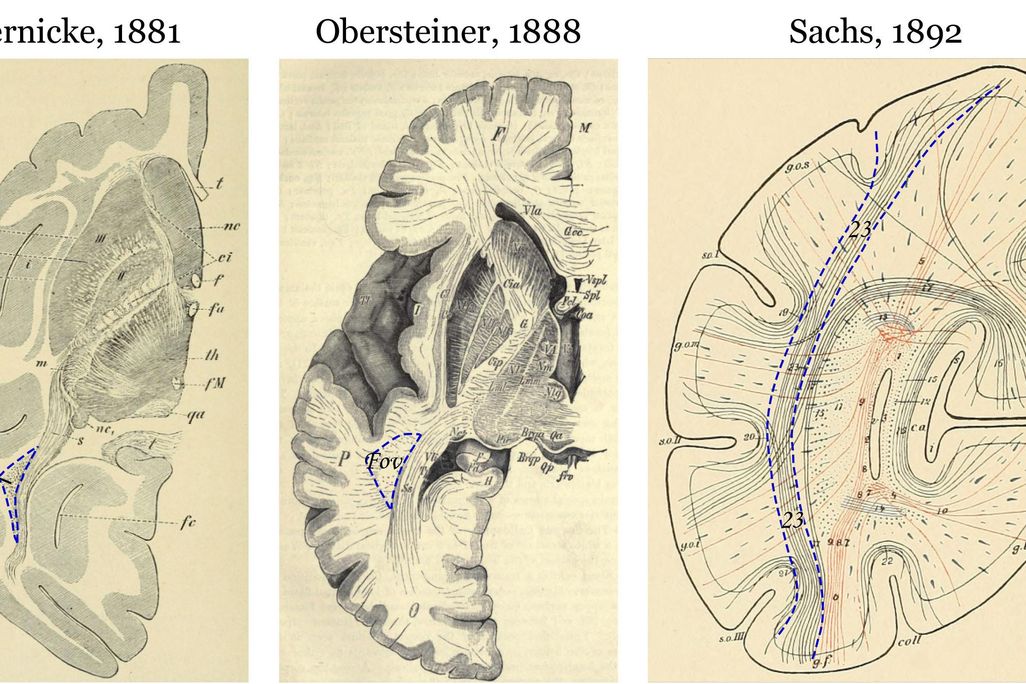 wernicke missing brain part