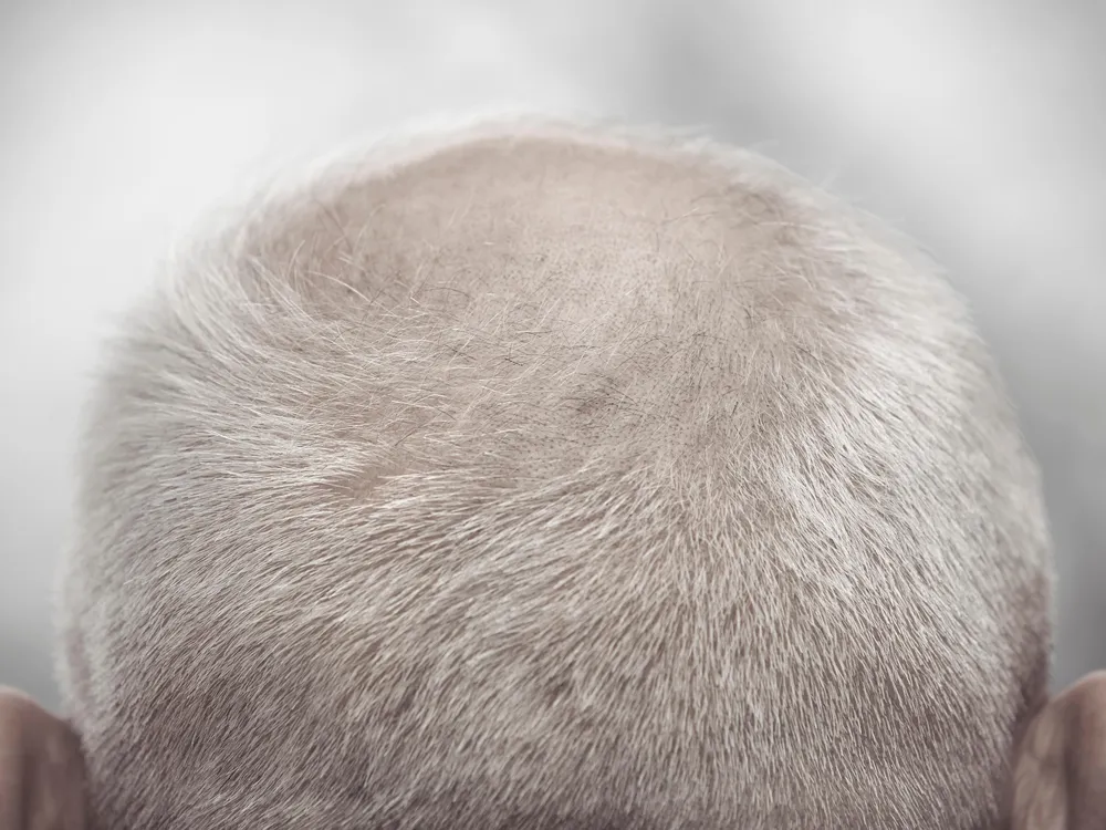 Pulling Your Hair Out? It Might Just Help Reverse Baldness | Science|  Smithsonian Magazine