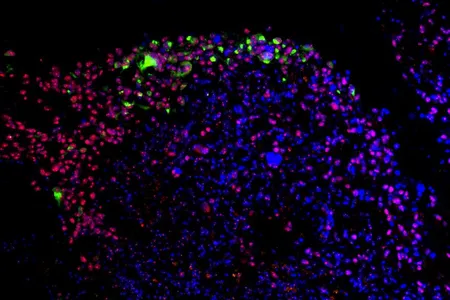 An image of cells showing Zika virus (highlighted green) targeting the cancerous stem cells (highlighted red) of a human glioblastoma tumor
