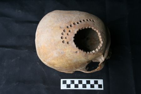 A 900 year-old skull from Peru, whose former owner underwent brain surgery.