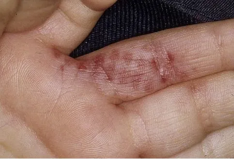 Person's hand with red welts