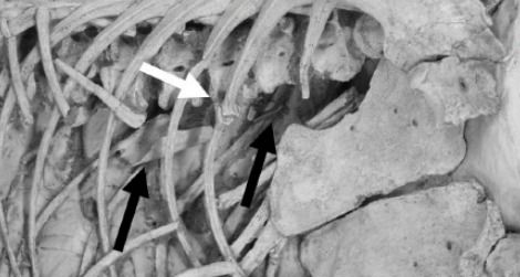 The chest cavity