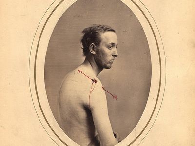 Peter Strien was 21 years old when he was wounded at the battle of Fort Steadman. 