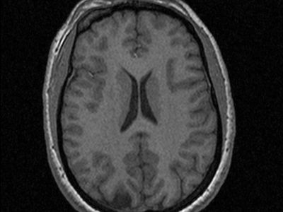 A functional magnetic resonance image of a brain.