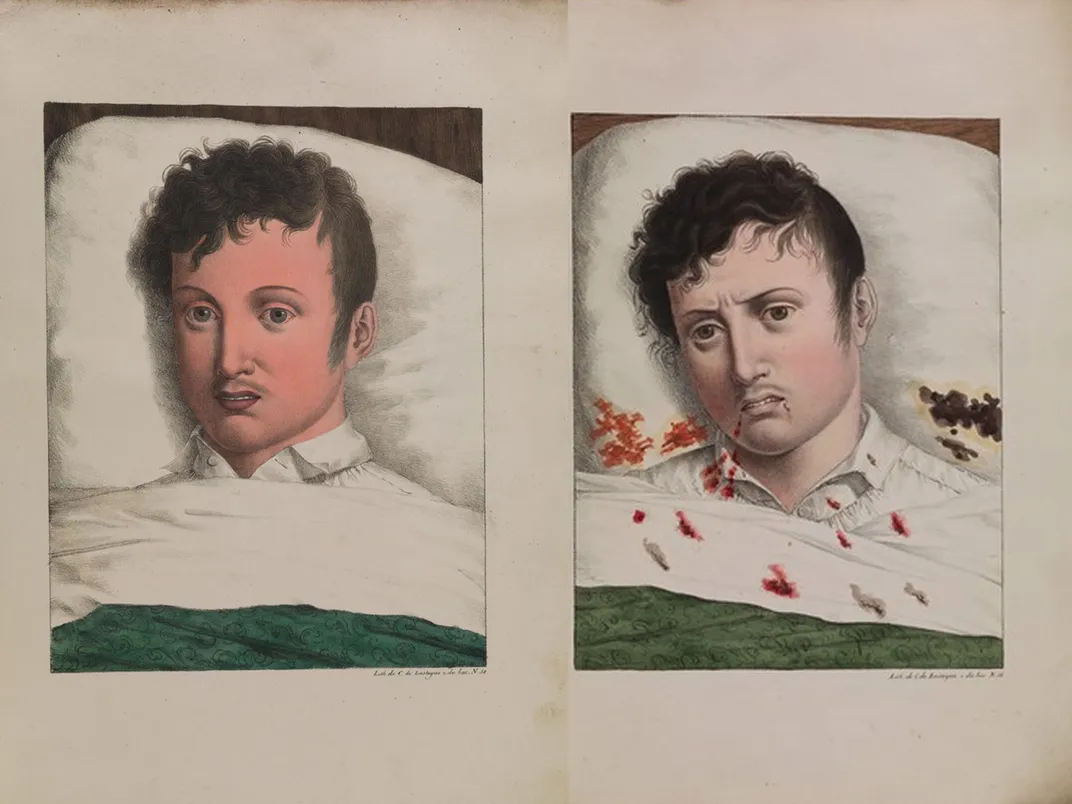 Illustration showing the development of yellow fever in a patient in Cadiz, Spain, in 1819