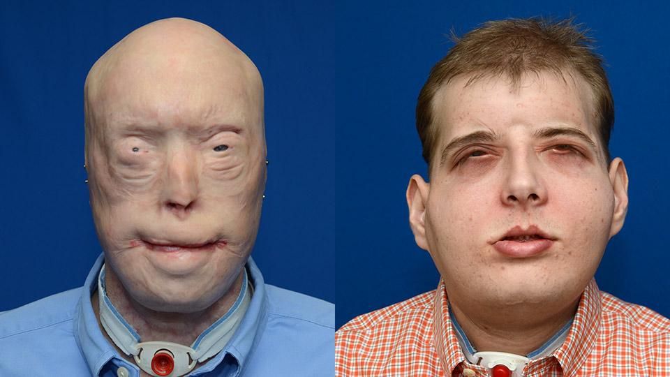 Saving Face: How One Pioneering Surgeon Is Pushing the Limits of Facial Transplants