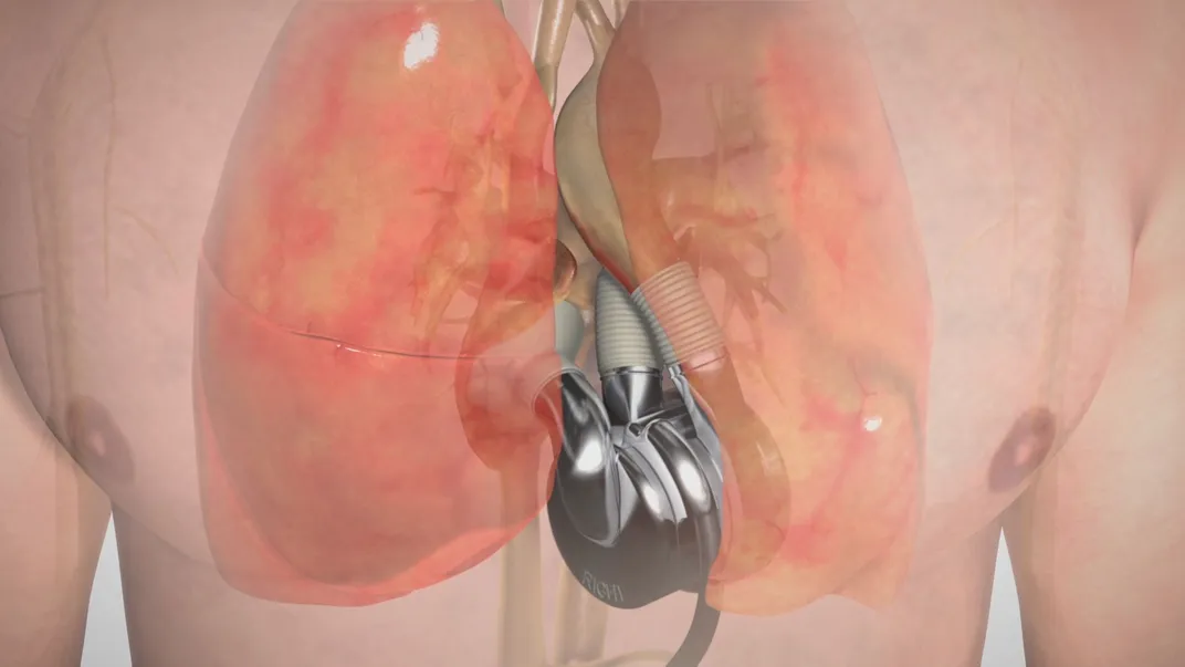 Rendering of a device inside a human torso