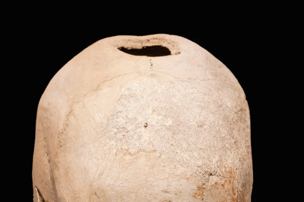 Trepanation