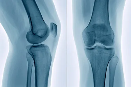 An X-ray of the knee bone.