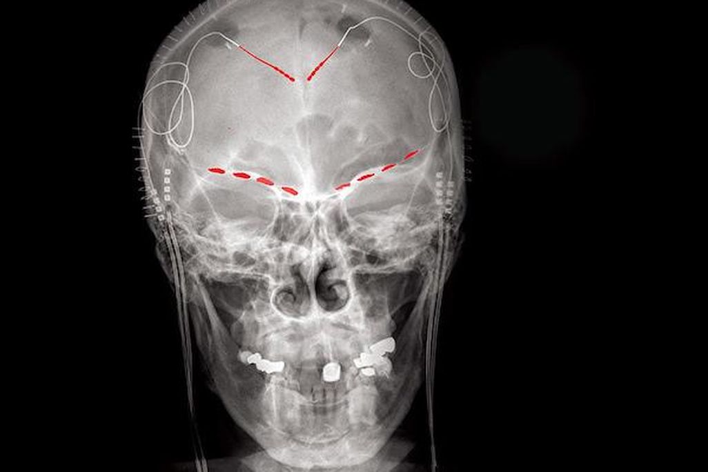 skeleton with red lines above the eyes and near the top of the skull