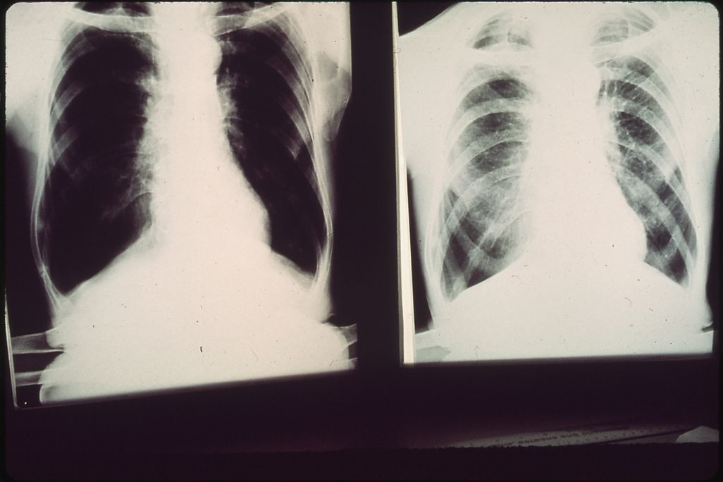 Black lung x-ray