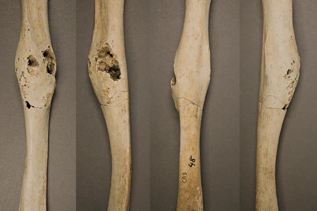 Right humerus bone