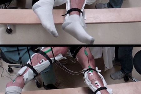 A paralyzed subject moves his legs with the help of transcutaneous stimulation.