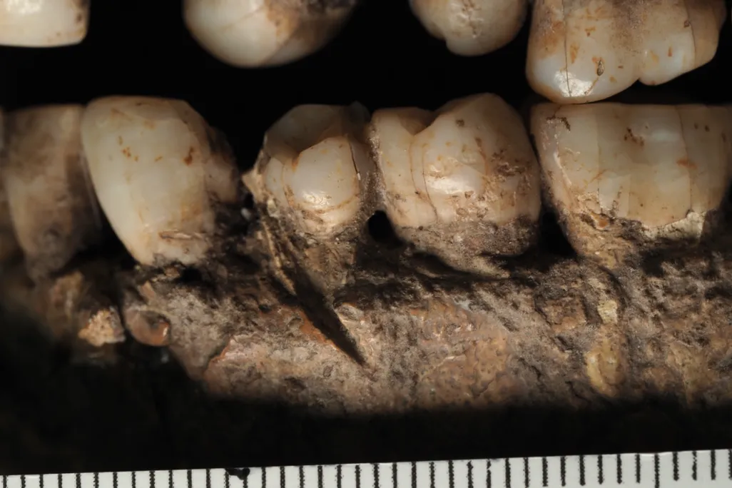 A close-up shot of human teeth and jaw bone