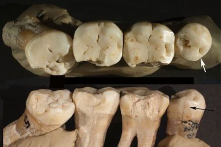 The Neanderthal teeth, including the impacted molar