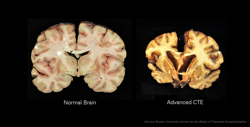 Memory and Brain Differences in Former NFL Players Who Lost