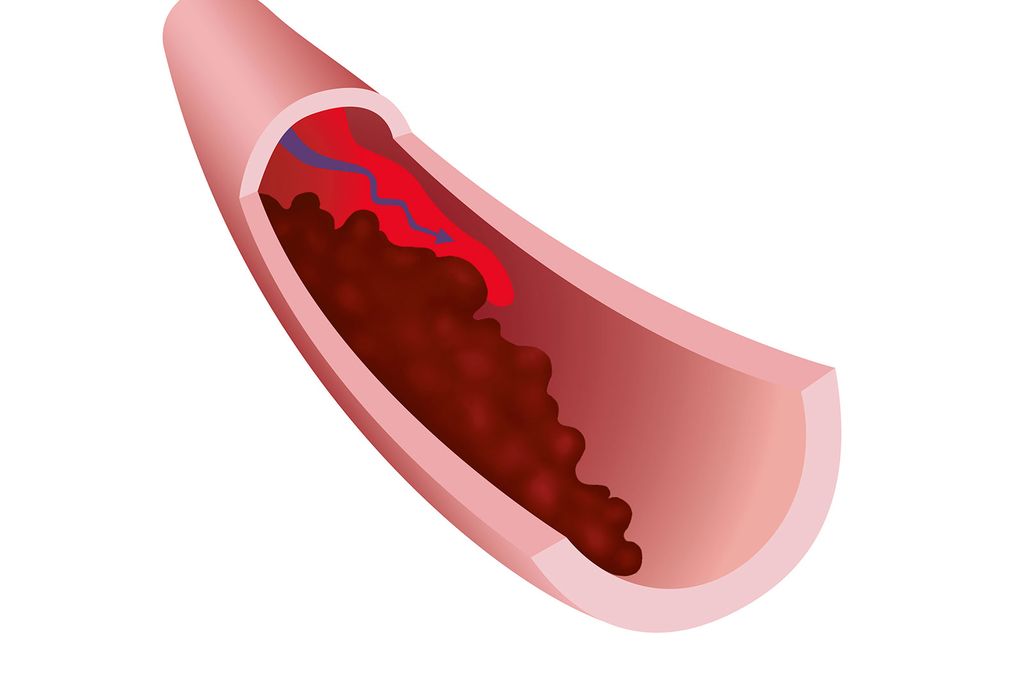 Blood Clot