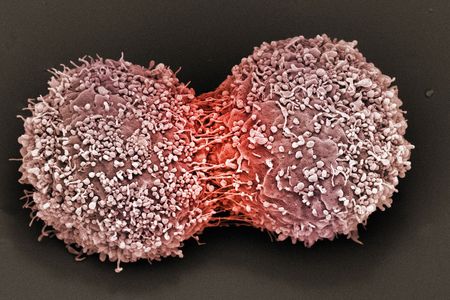 Breast cancer cells dividing.