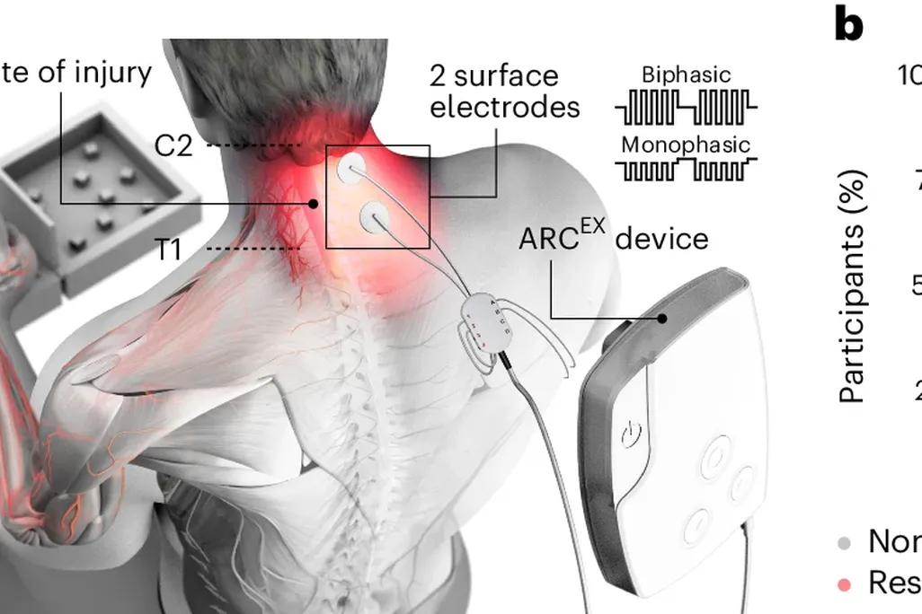 An artist's rendering shows where Arc-Ex is placed on a person's neck to stimulate electric pulses on their spinal cord.