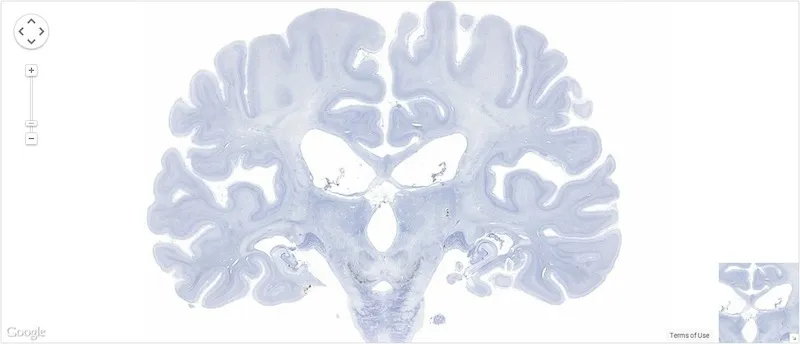 A Postmortem of the Most Famous Brain in Neuroscience History