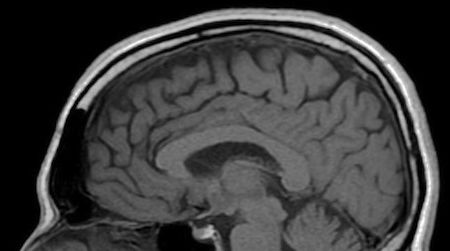 Researchers have found neurological abnormalities that persist long after the symptoms of a concussion have faded away.