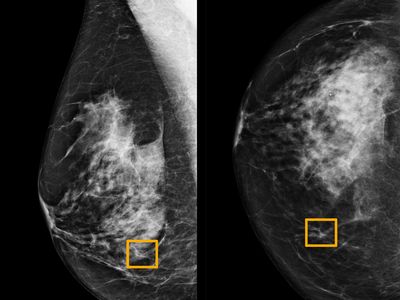 A yellow box indicates where an AI system found cancer hiding inside breast tissue. 