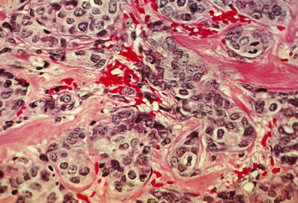 An image of cancerous breast tissue under a microscope. It has long strands of red and pink tissue with round, purple/blue cancer cells throughout.